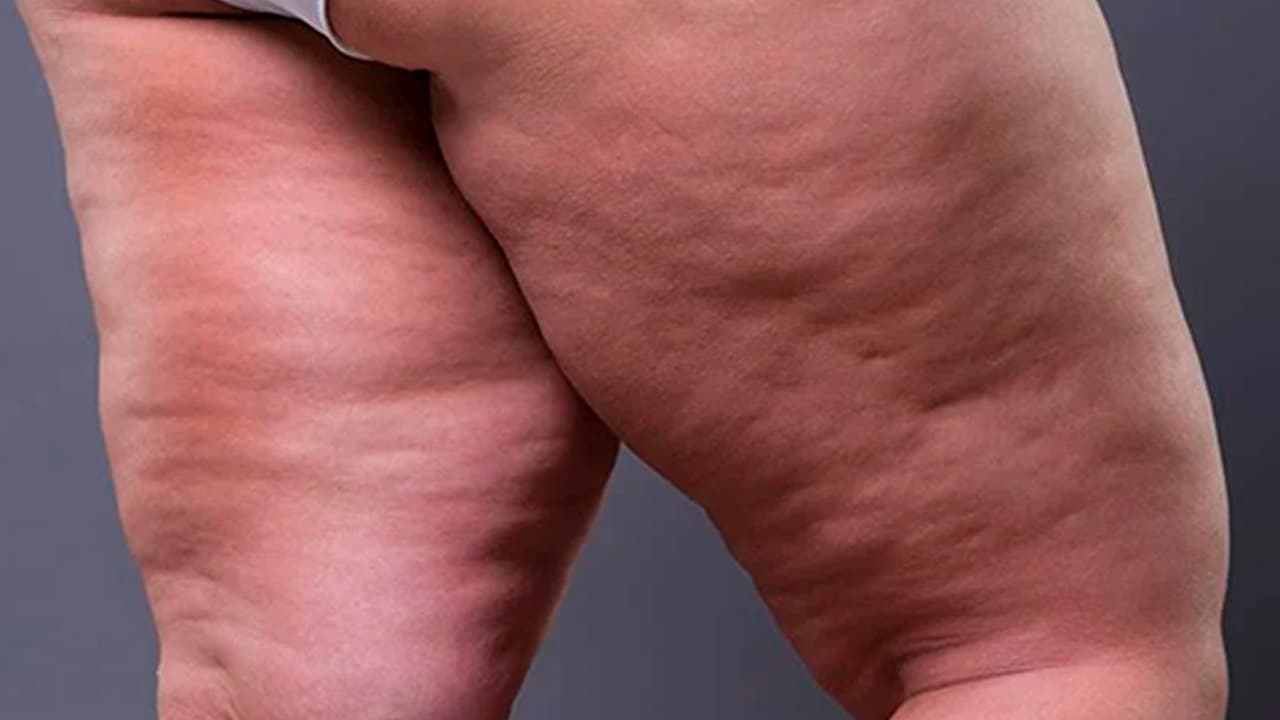 Workshop gravado - CELULITE: COMO EU TRATO?