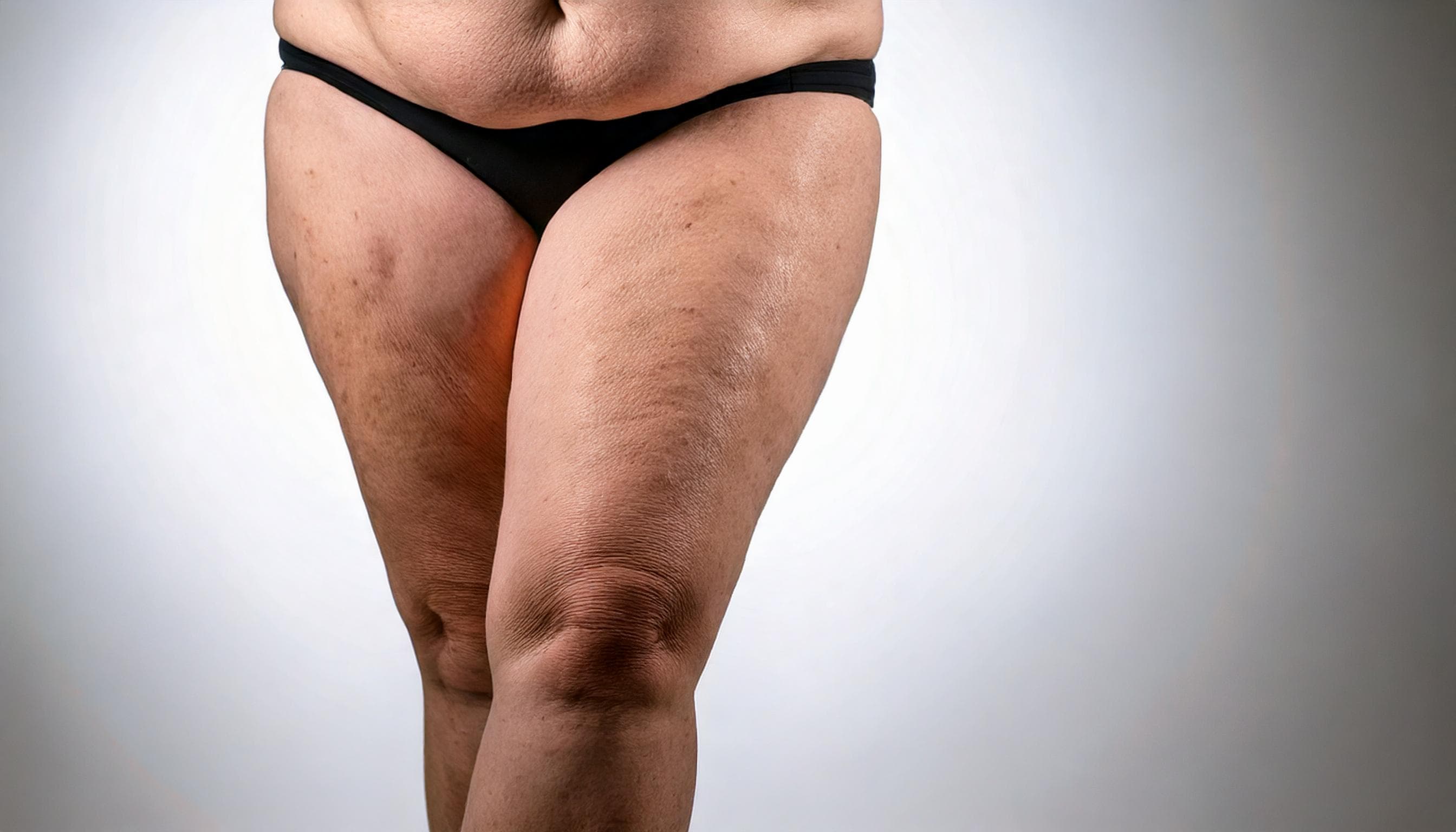 Curso gravado - ATUAÇÃO EM LIPEDEMA: DO DIAGNÓSTICO AO TRATAMENTO