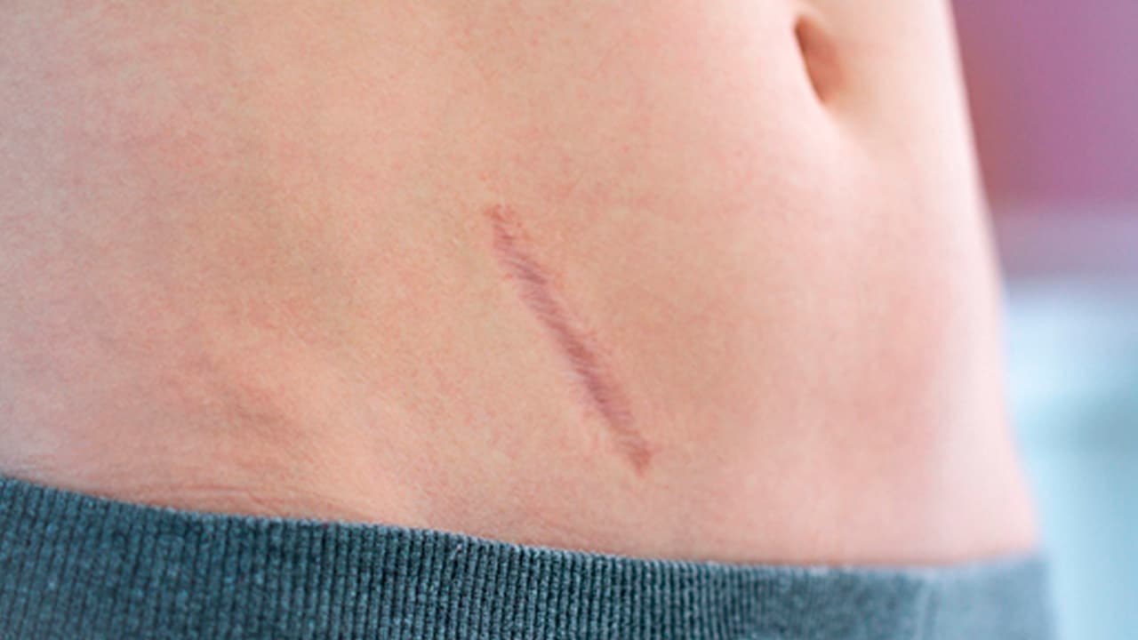 Workshop grabado - CICATRIZ: ¿CÓMO LA TRATO?